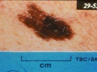 Atypical nevus, skin cancer symptoms