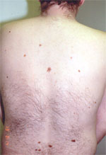 Patient with multiple atypical nevi, skin cancer treatment