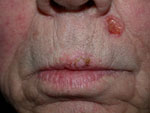 Basal cell Carcinoma of the left upper lip, skin cancer treatment 