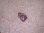 Malignant melanoma, skin cancer treatment