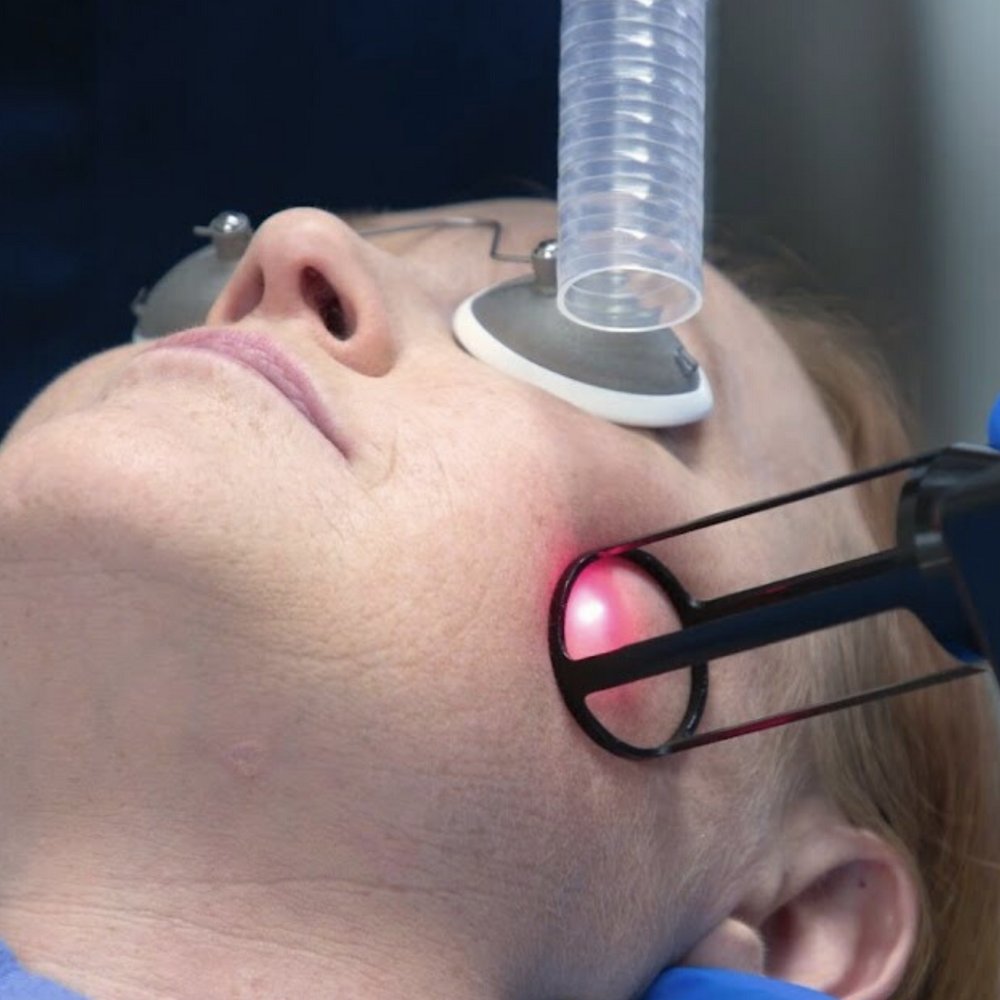 laser resurfacing in skin experts polyclinic in dubai