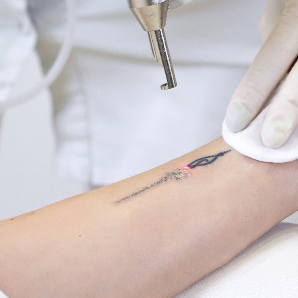 laser tattoo removal procedure in Skin Experts Polyclinic, Dubai