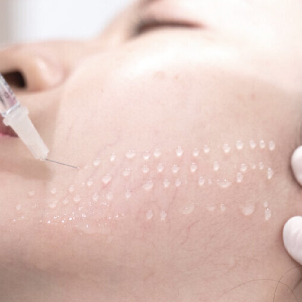 mesotherapy treatment in dubai