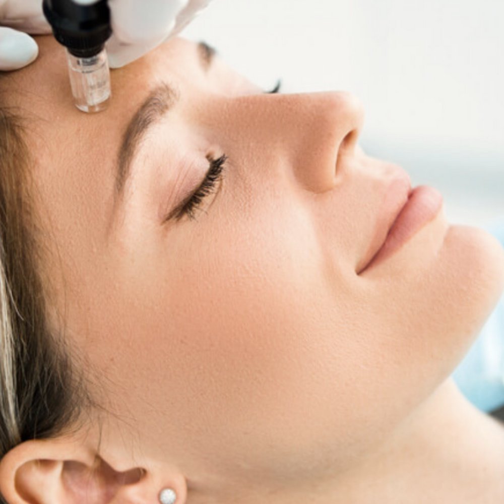 Radiofrequency Microneedling Treatment Clinic in Dubai