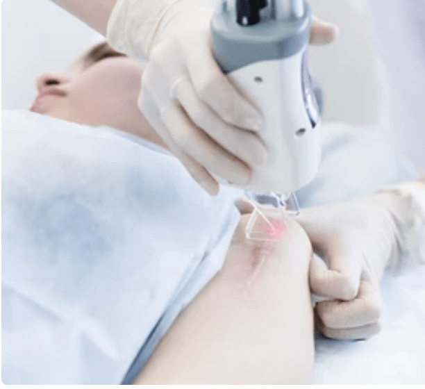 laser scar treatment in skinexperts