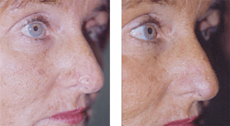 Skin Cancer Treatment in Dubai, Before and after