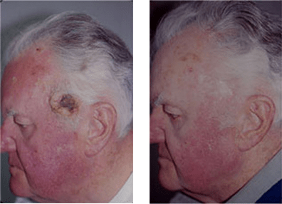 Skin Cancer Treatment in Dubai, Before and after