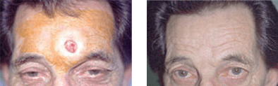 Skin Cancer Treatment in Dubai, Before and After