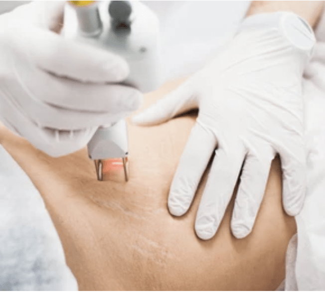 scar and stretch mark removal clinic in dubai