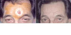 defect after mohs surgery repaired with skin flap