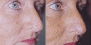 basal cell carcinoma after mohs surgery and skin graft.png