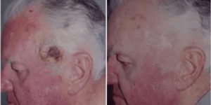squamous cell carcinoma after mohs surgery and skin graft.png