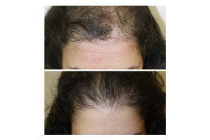 Horizontal hair restore1