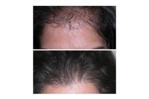Horizontal hair restore2