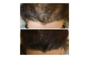 Horizontal hair restore3