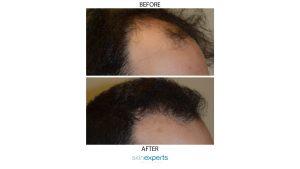 Horizontal hair restore4