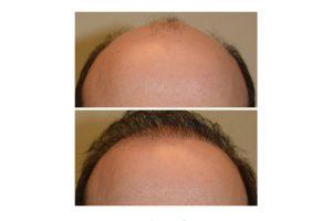 Horizontal hair restore5