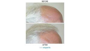 Horizontal hair restore6