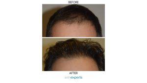 Horizontal hair restore7