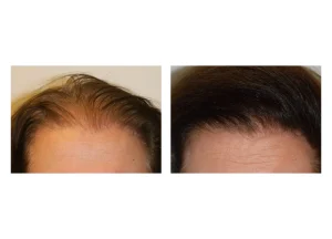 hair restore SE 07 scaled