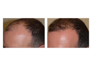 hair restore SE 13 scaled