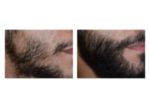 hair restore SE 18 scaled