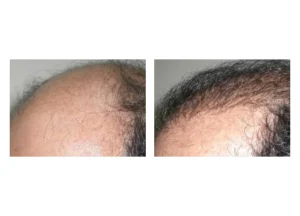 hair restore SE 25 scaled