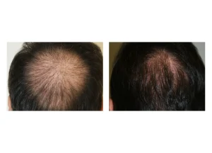 hair restore SE 27 scaled