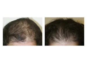 hair restore SE 28 scaled