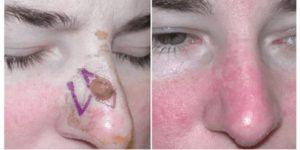 mohs surgery gallery 01.png