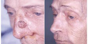 mohs surgery gallery 02.png