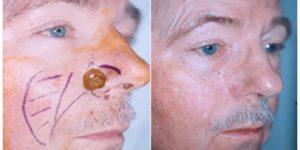 mohs surgery gallery 03.png