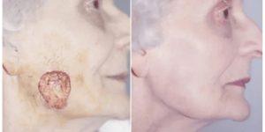 mohs surgery gallery 04.png