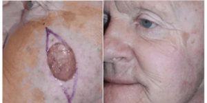 mohs surgery gallery 05.png