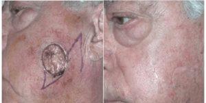 mohs surgery gallery 06.png