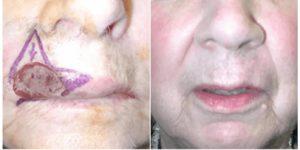 mohs surgery gallery 11.png