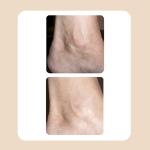 10.Vascular Laser