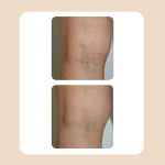 11.Vascular Laser