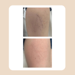 12.Vascular Laser