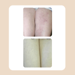 13.Vascular Laser