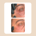 14.Vascular Laser