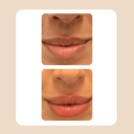 16.Lip Rejuvenation Augmentation
