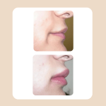 17.Lip Rejuvenation Augmentation