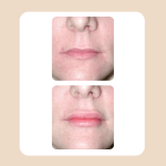 18.Lip Rejuvenation Augmentation