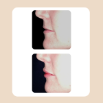 19.Lip Rejuvenation Augmentation