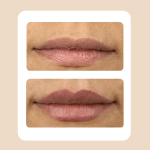 20.Lip Rejuvenation Augmentation
