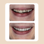 21.Veneers