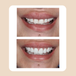 22.Veneers