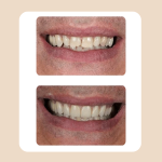 23.Veneers