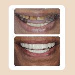 24.Veneers